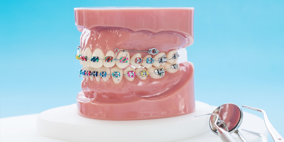 Lingual Braces