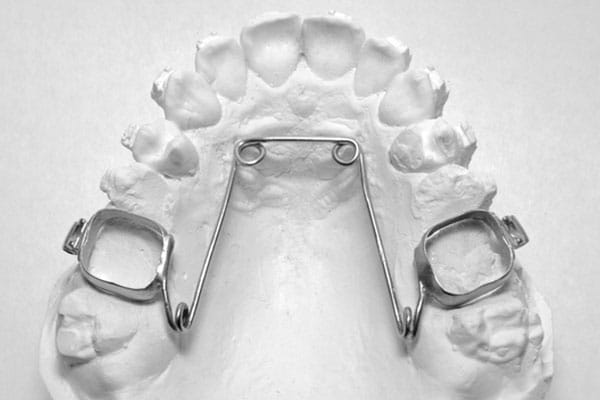 Self-Ligating Braces